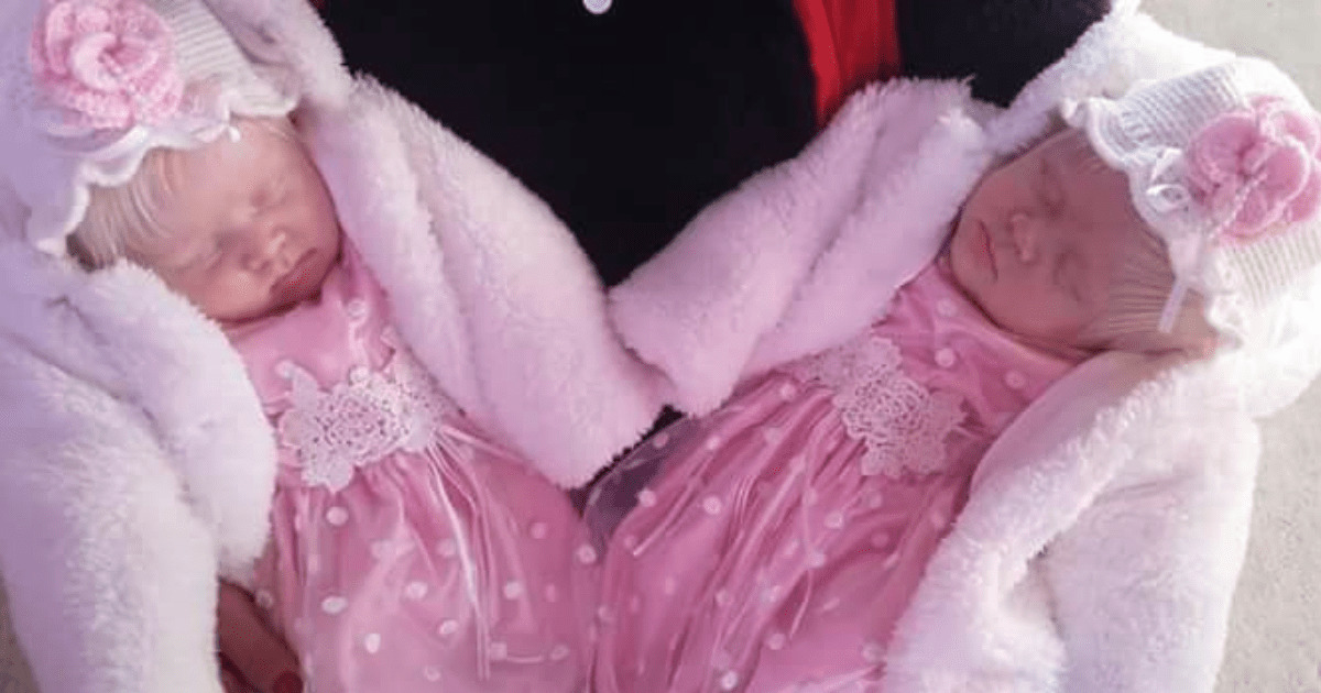 Twins with snow-white hair show their beauty years after being born