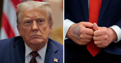 Donald Trump has sported a bruise recently. Credit / Getty Images