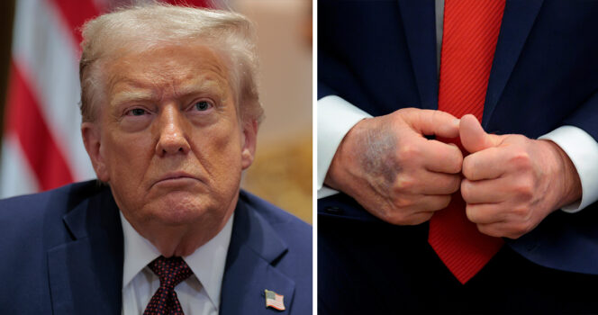 Donald Trump has sported a bruise recently. Credit / Getty Images
