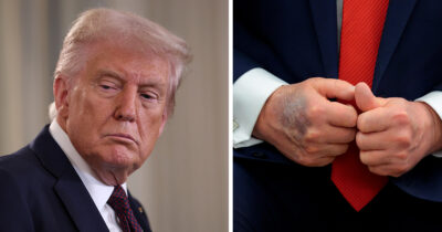 Donald Trump has had several hand bruises over the past few months. Credit / Getty Images