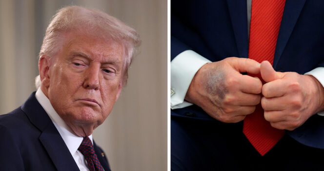 Donald Trump has had several hand bruises over the past few months. Credit / Getty Images