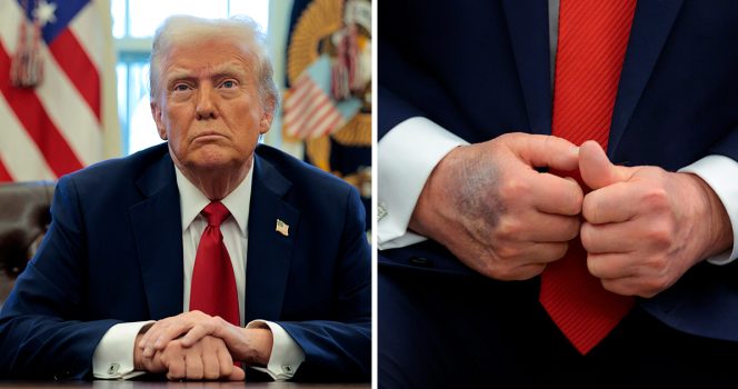 One doctor has claimed Donald Trump suffered a stroke last year. Credit / Getty Images