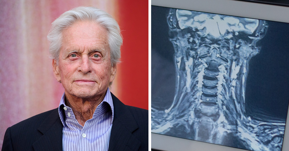 Michael Douglas & throat scan. Credit / Getty Images & Shutterstock