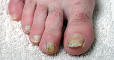 Discoloured toenails can be a serious warning sign. Credit / Shutterstock