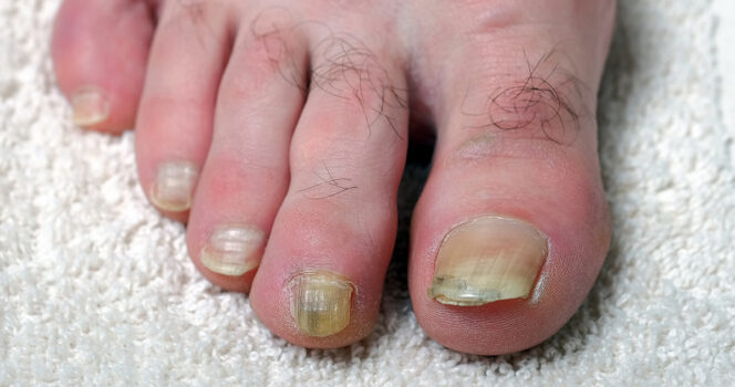 Discoloured toenails can be a serious warning sign. Credit / Shutterstock