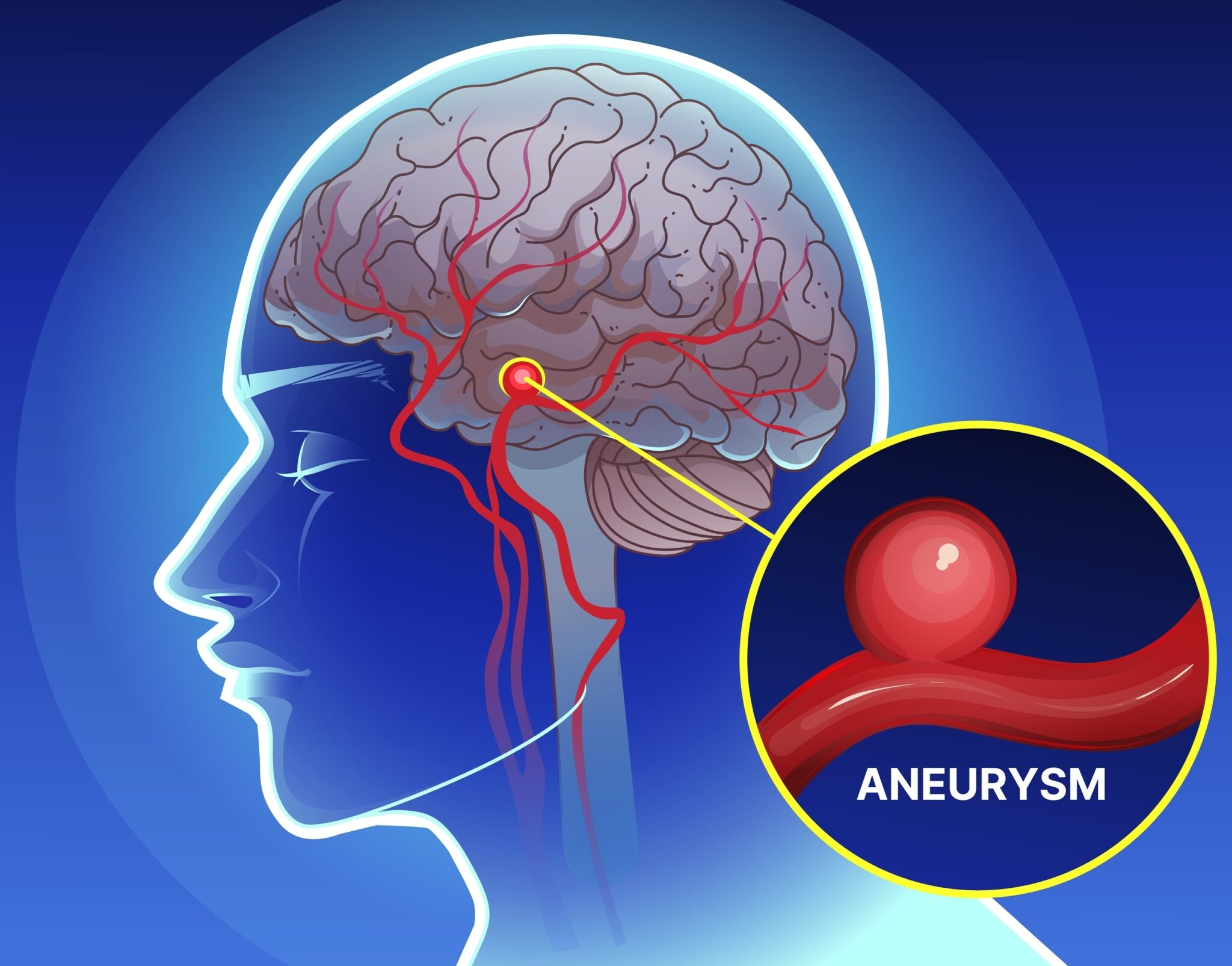 12 early warning signs of an aneurysm you shouldn’t ignore