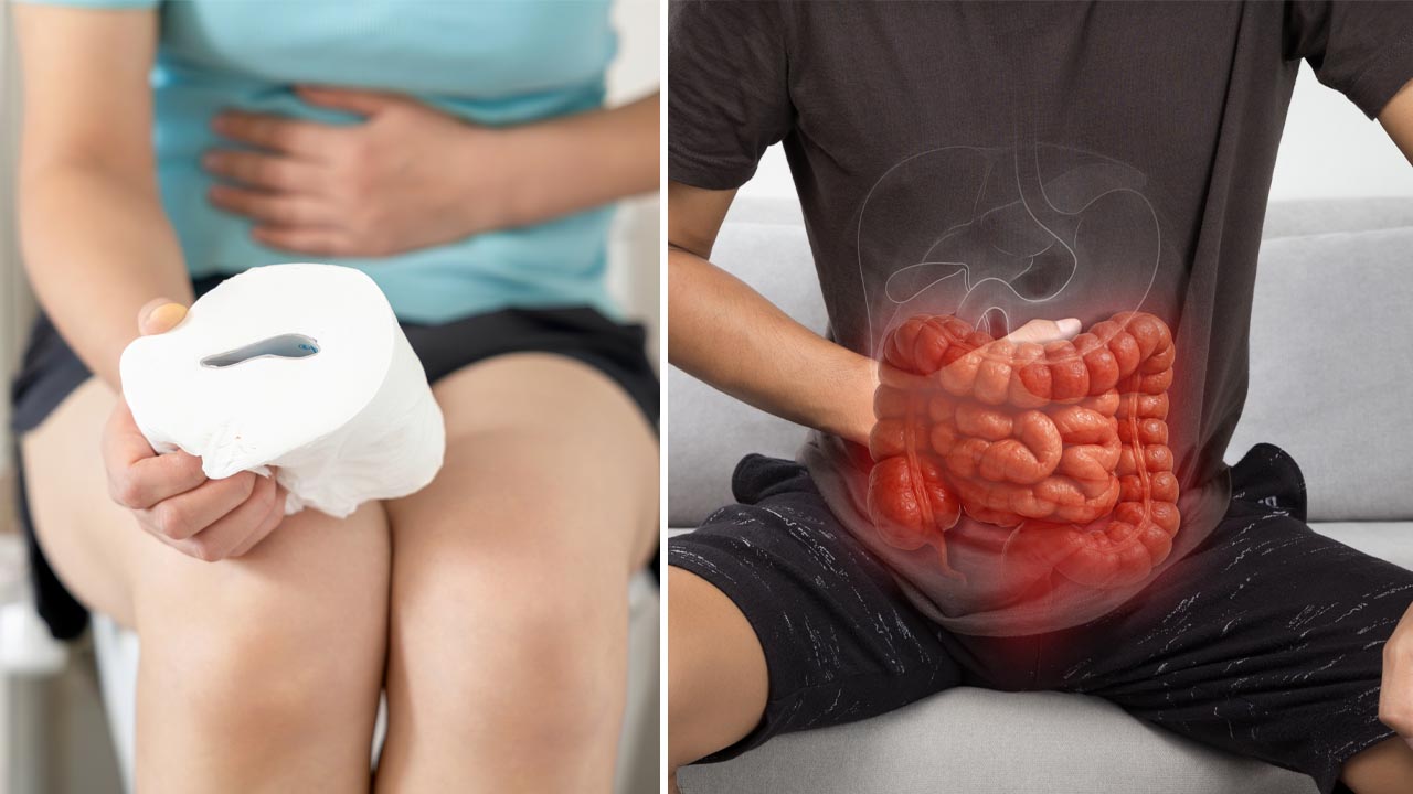 Bowel cancer