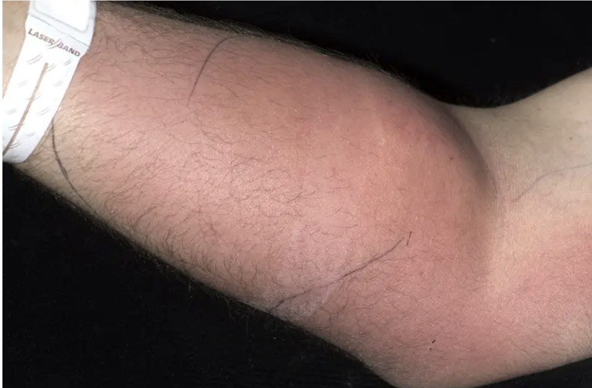 Man injecting himself with his own semen