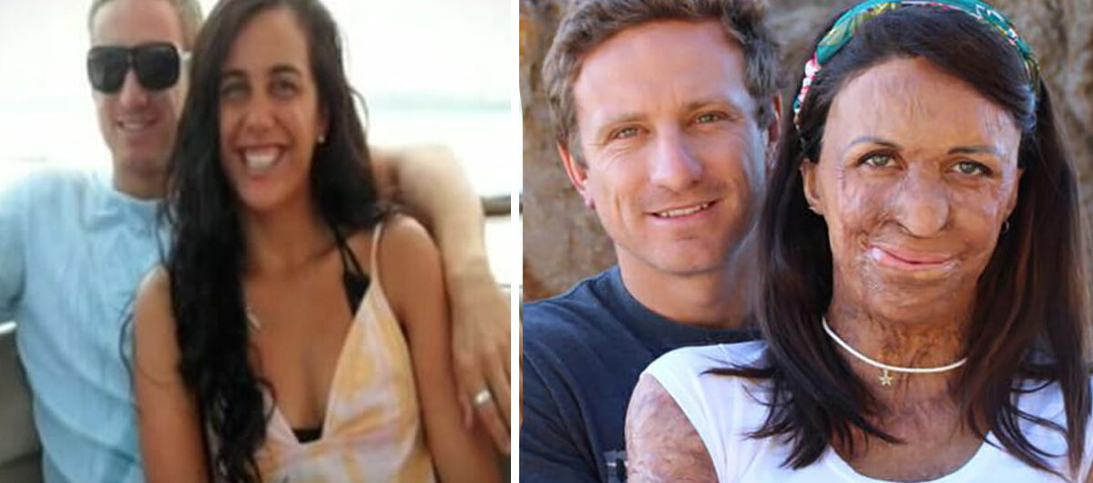 Turia Pitt brännskadades svårt i en skogsbrand