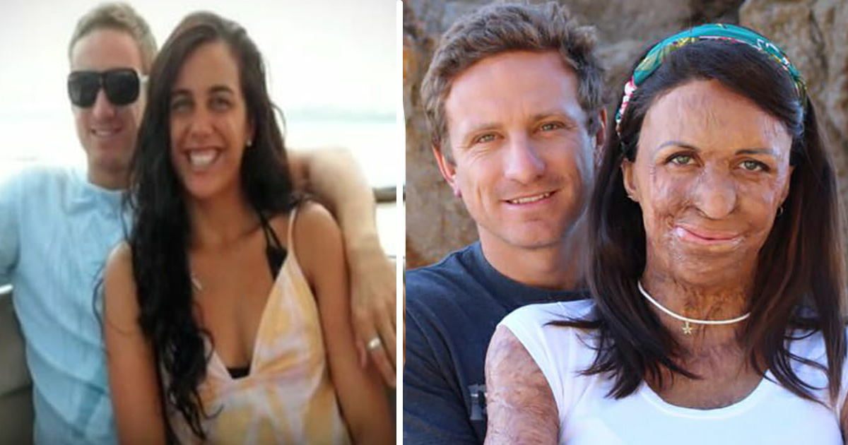 Turia Pitt brännskadades svårt i en skogsbrand