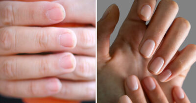 Hur dina naglar ser ut kan visa hur det står till med din hälsa
