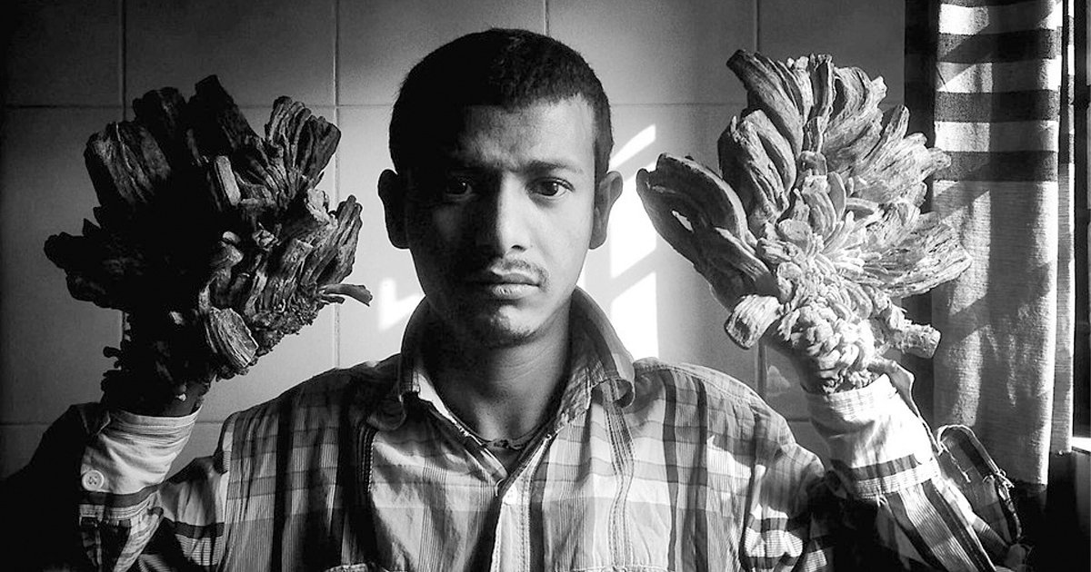 Abul Bajandar kallades "trädmannen"