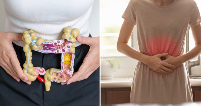 Tjocktarmscancer, ändtarmscancer