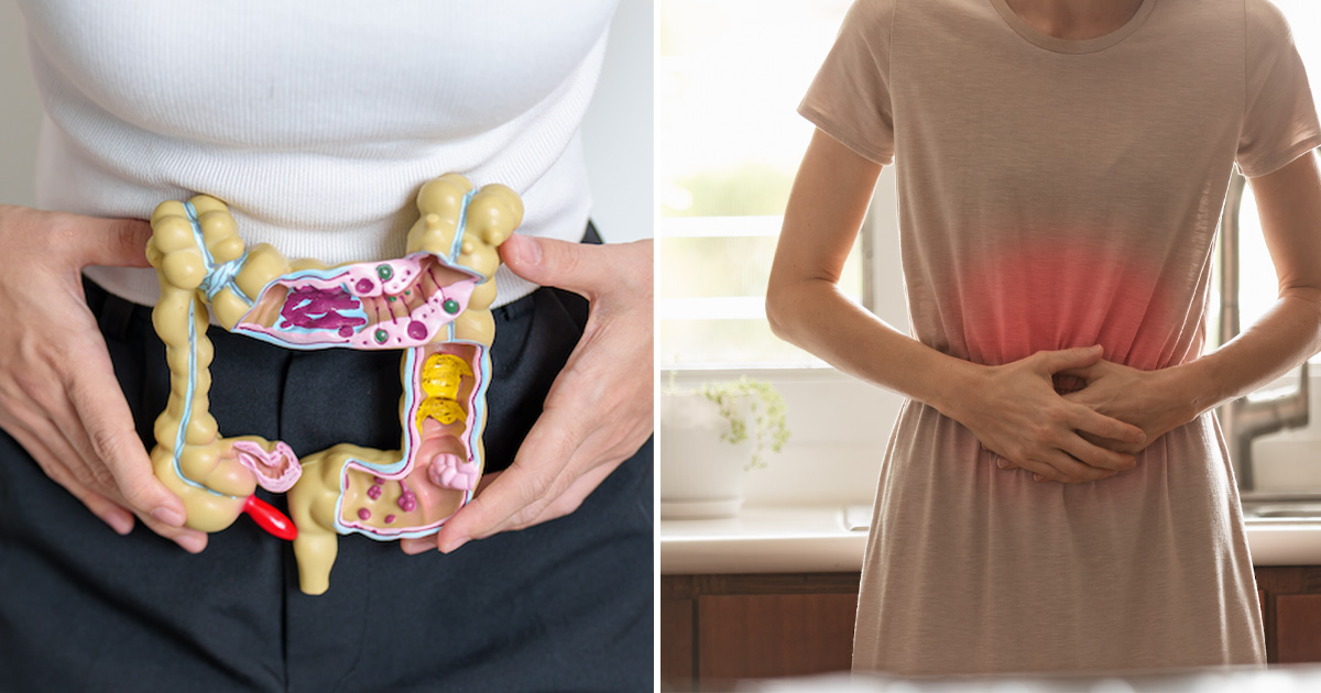 Tjocktarmscancer, ändtarmscancer