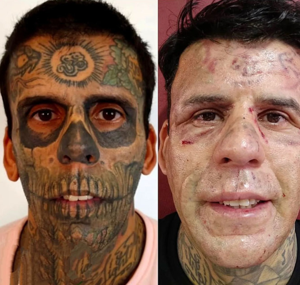 Leandro de Souza przed zabiegiem laserowym i po