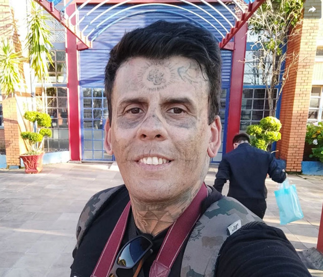 Leandro de Souza po zabiegach laserem