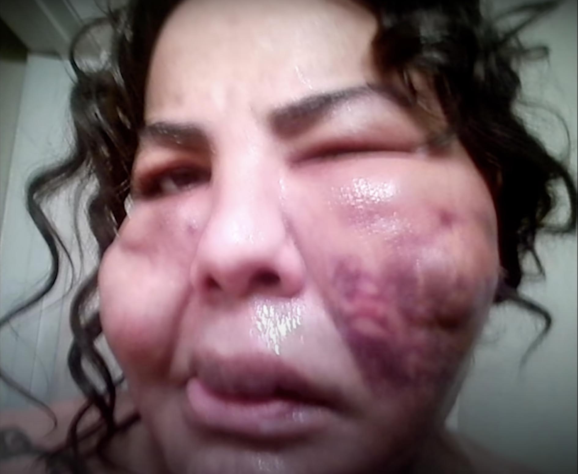 Rajee Narinesingh po nieudanych zabiegach