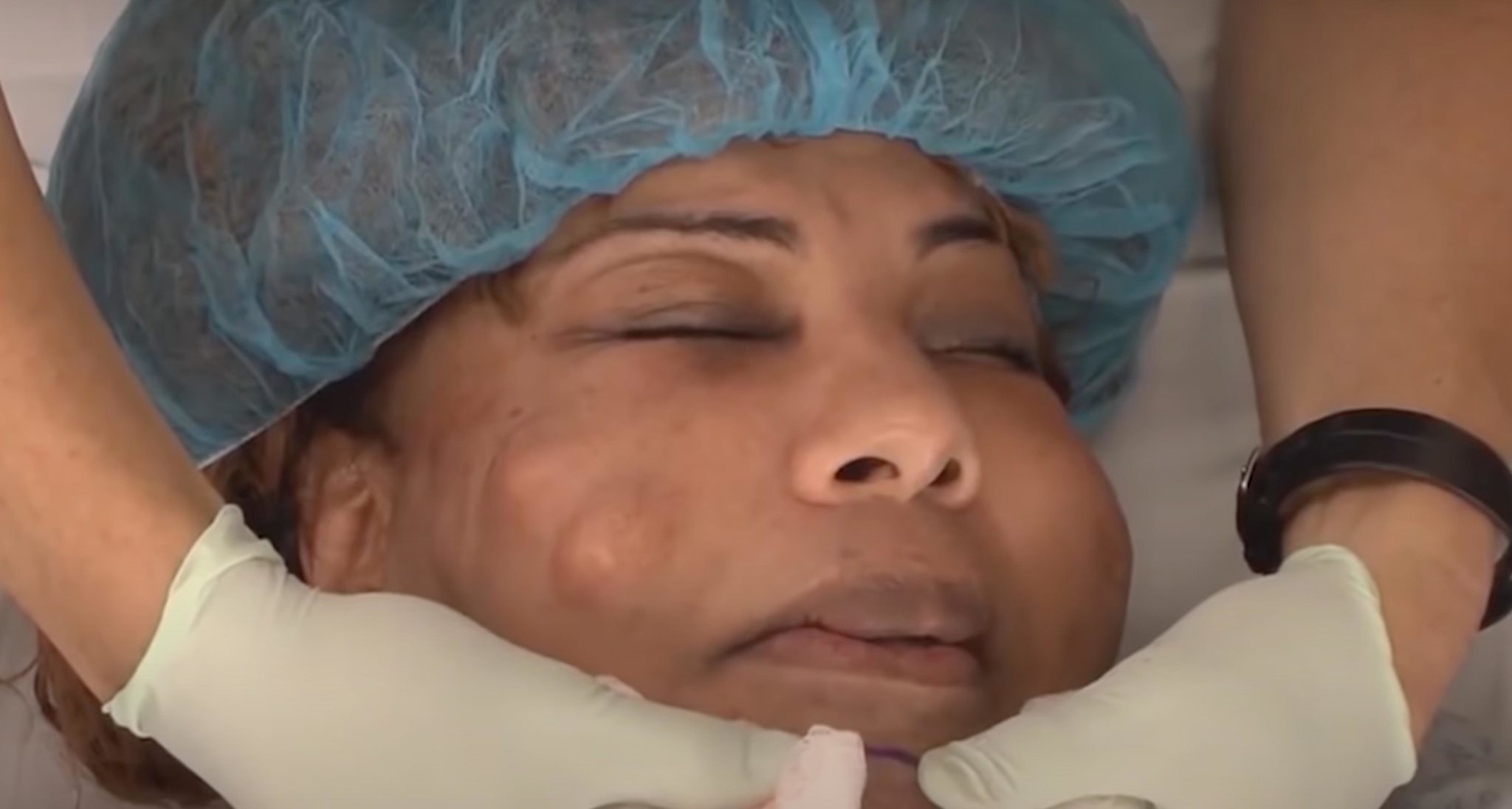 Rajee Narinesingh w czepku na głowie w trakcie zabiegu