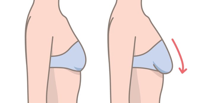 rysunek kobiety w biustonoszu z jędrnym i obwisłym biustem