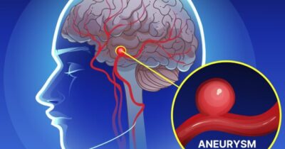tętniak mózgu