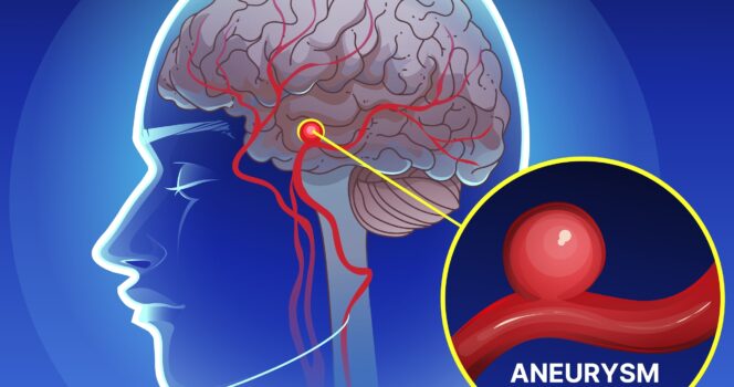 tętniak mózgu