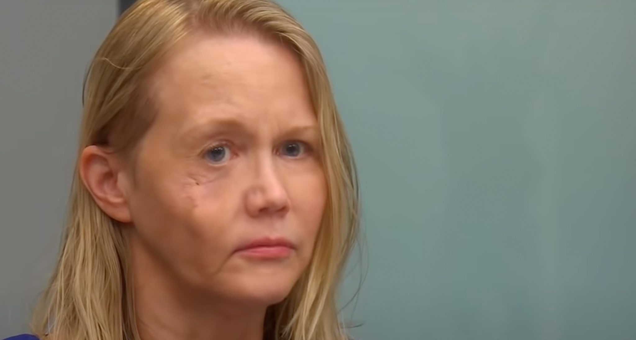 Gina Anderson z powikłaniami po wypełniaczach