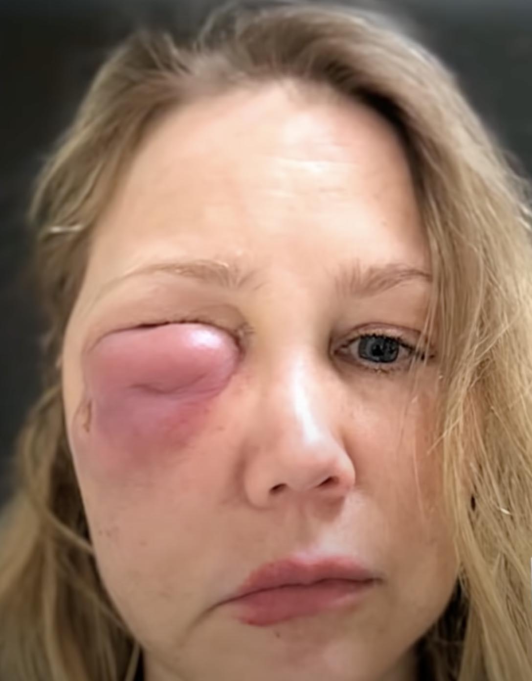 Gina Anderson z gigantycznym stanem zapalnym