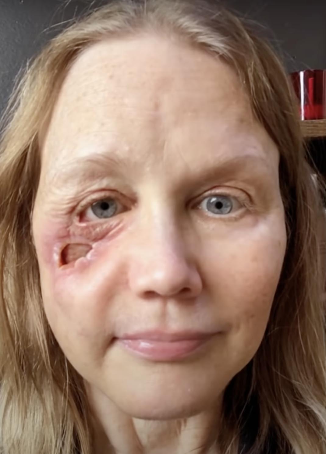 Gina Anderson z dziurą w policzku