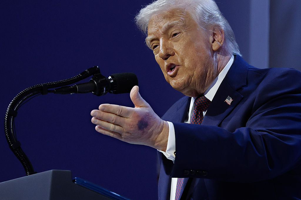 Donald Trump z siniakiem na dłoni
