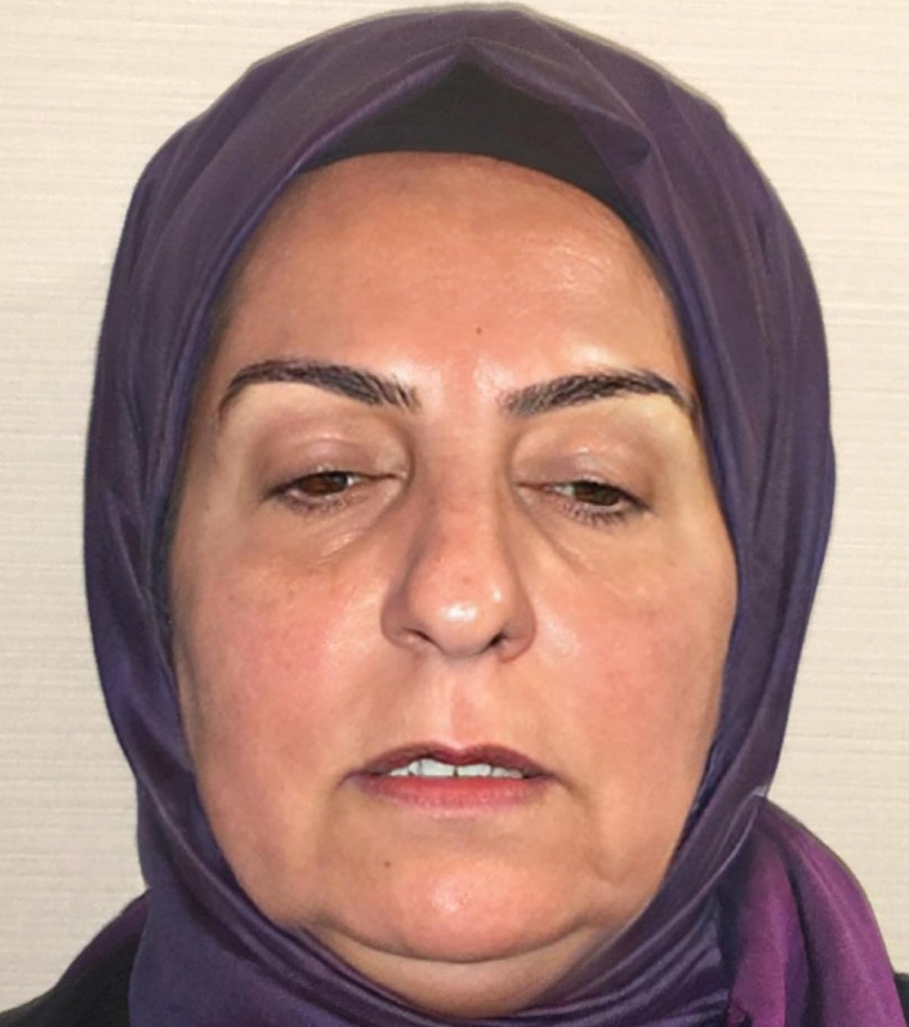 pani Dilek przed zabiegiem