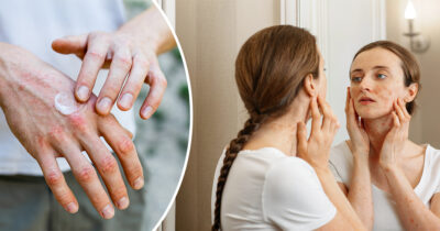 Psoriaasia käsissä. Psoriaasia kasvoissa nainen katsoo peiliin. Kvat: Shutterstock.
