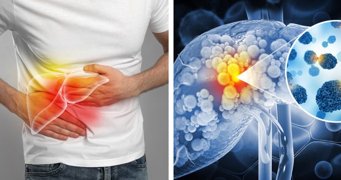 Maksasyövän ennuste on usein huono, sillä tauti havaitaan ja diagnosoidaan vasta liian myöhään.