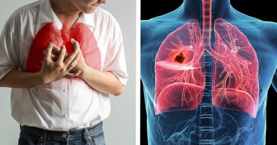 Keuhkosyöpä. Kuva: Shutterstock