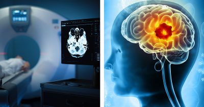 Magnettikuva (vas.) ja aivokasvain