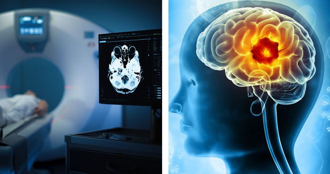 Magnettikuva (vas.) ja aivokasvain