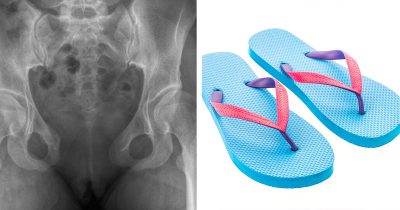 Röntgenkuva ja kuva sandaaleista.