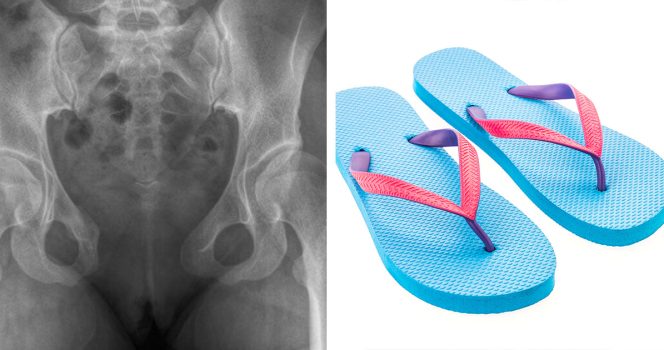 Röntgenkuva ja kuva sandaaleista.