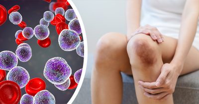 Leukemia, mustelma. Kuvat: Shutterstock