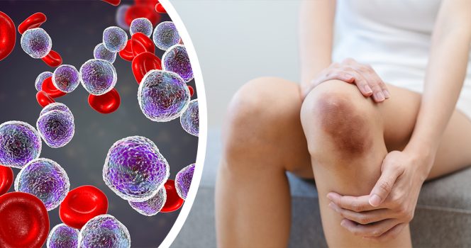 Leukemia, mustelma. Kuvat: Shutterstock