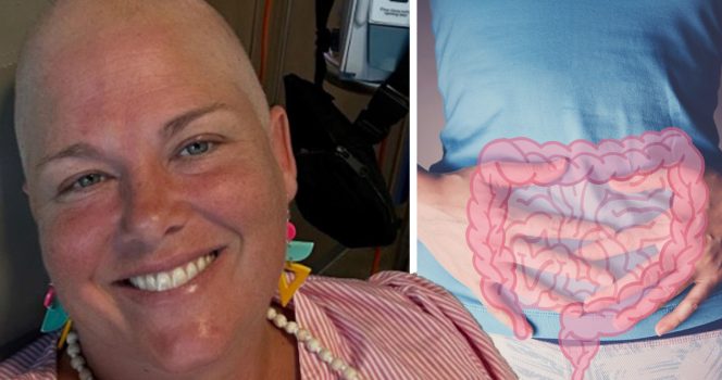 Suolistosyöpään sairastunut Susan Schmidt kertoo nyt oireet, jotka sivuutti liian pitkään ennen diagnoosia.