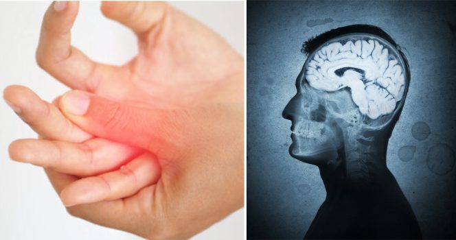 ALS on vakava motoneuronisairaus, joka vaikuttaa selkäytimessä kulkevien liikehermojen toimintaan tuhoten ne.