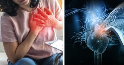 Sepelvaltimotauti voi alkaa salakavalasti.