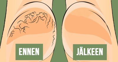 Kantapäät on helppo hoitaa kuntoon oikeilla ohjeilla