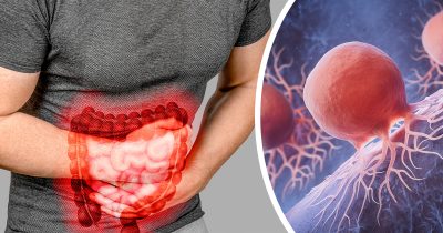 Suolistosyöpä. Kuvat Shutterstock