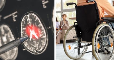 Kuva aivoista (vas.) ja pyörätuolia käyttävästä henkilöstä. MS-tauti vaikuttaa muun muassa liikuntakykyyn.