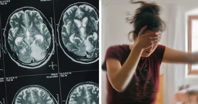 Kuvia aivoista (vas.), nainen, jota huimaa. Aivohalvauksen riskiä voi laskea pienillä arjen teoilla.