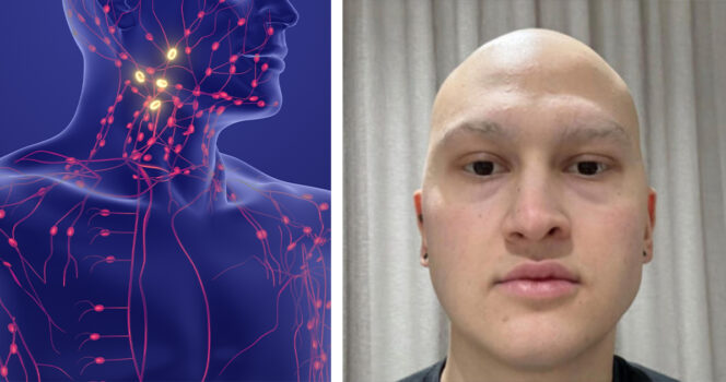 Syöpä. hodgkins lymphoma, Jay. Kuvat: Shutterstock, TikTok