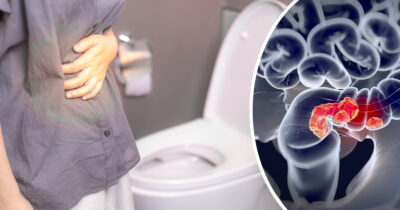 Suolistosyövät ovat usein aluksi vähäoireisia tai jopa täysin oireettomia.