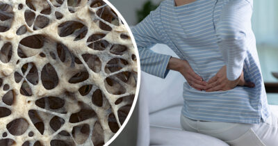 Osteoporoosi. Kuvituskuva. Shutterstock