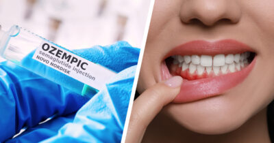 Ozempic, hampaat. Kuvat: Shutterstock
